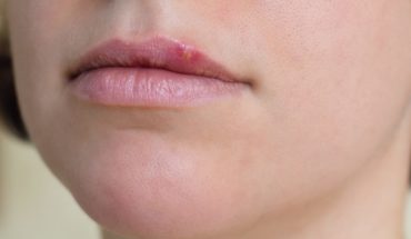 Quanto dura l'herpes